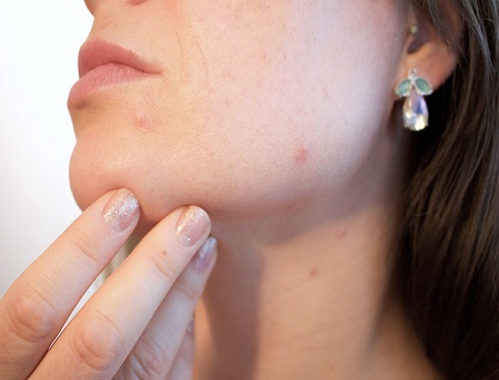 How to Combat Adult Acne