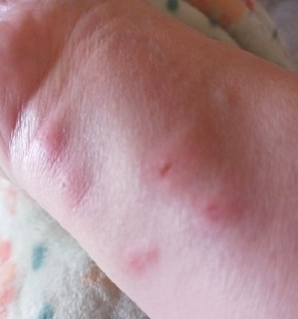 How to Treat Insect and Bug Bites