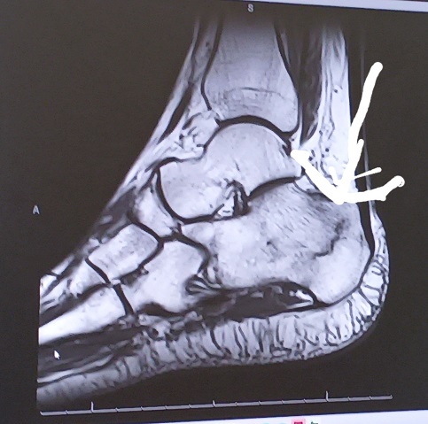 fractured heel xray