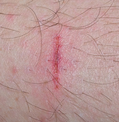 Dealing With a Painful or Slow-Healing Wound? Here’s What to Do