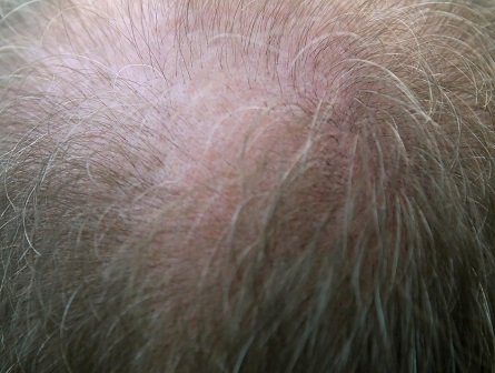 Tried Everything for Thinning Hair? Maybe Time For a Hair Transplant