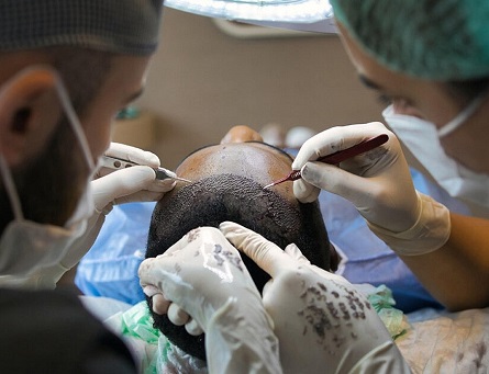 How to Choose the Right Surgeon for a Natural Hair Transplant