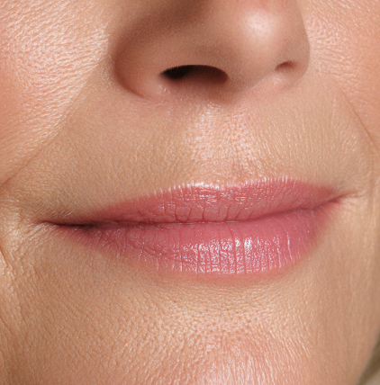 Subtle Lip Fillers