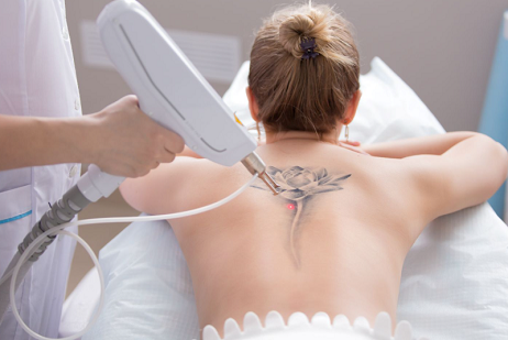 Tattoo Removal Perth: What to Know Before You Book Your First Session